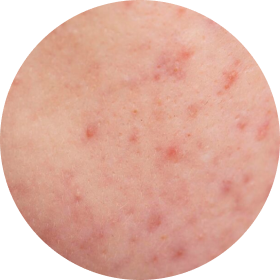 papules