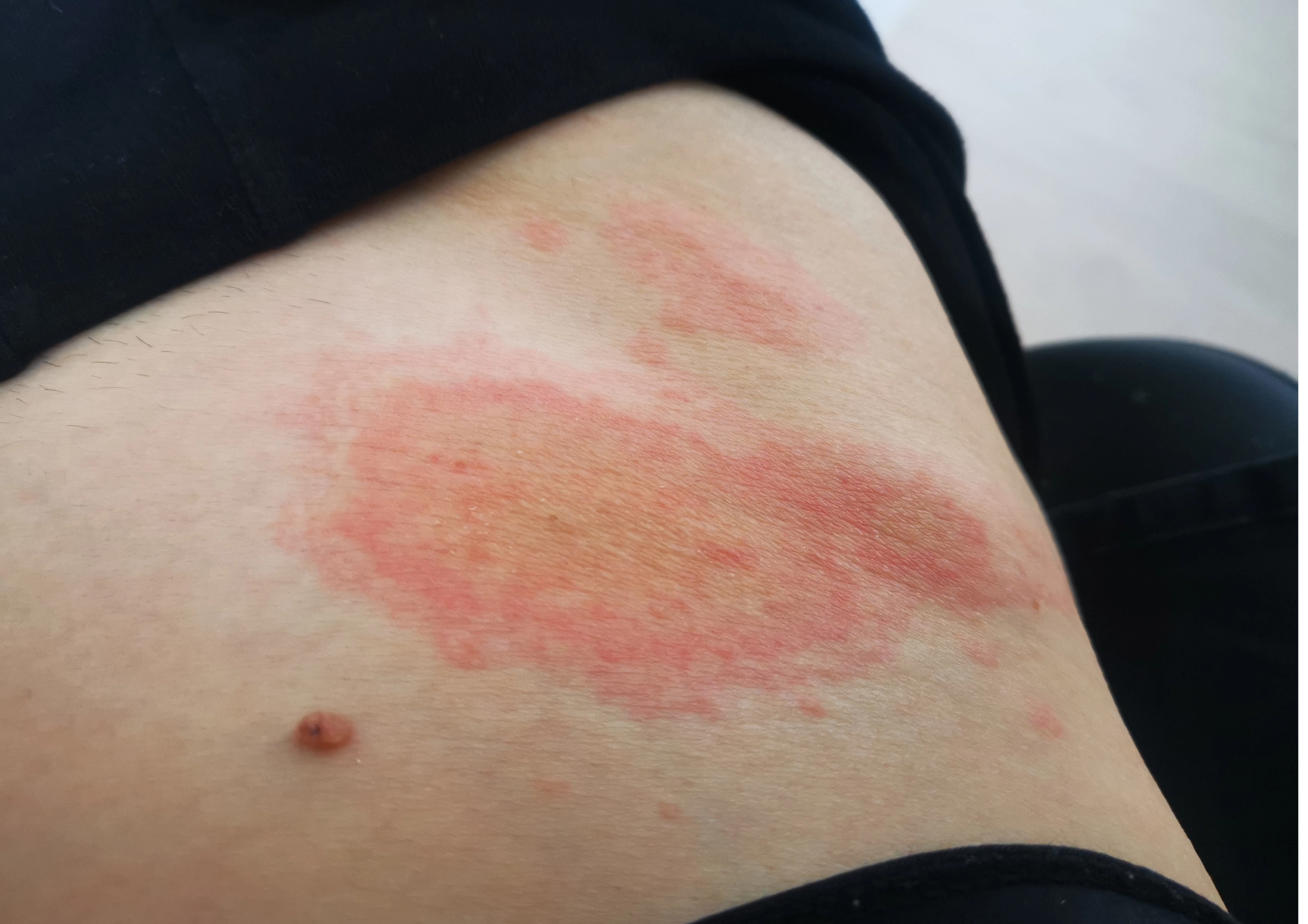 When Skin Becomes Extremely Sensitive or Eczema-Prone