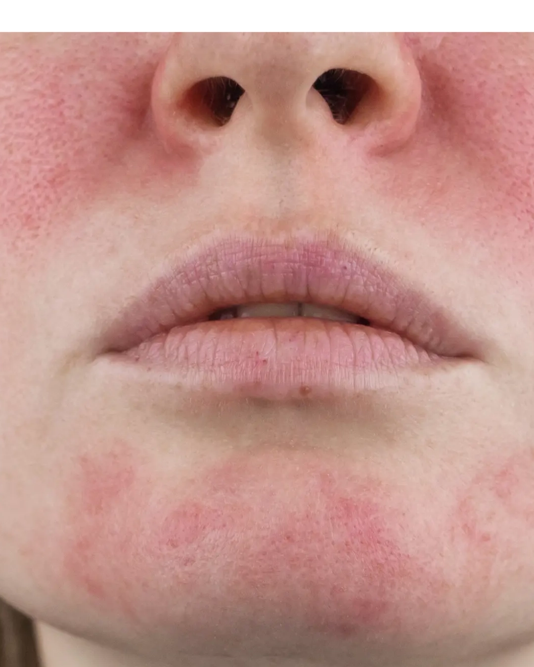 Ultra Sensitive Skin Relief Therapy