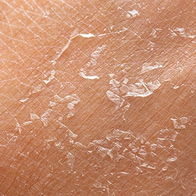 Dry Skin