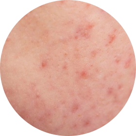 Papules